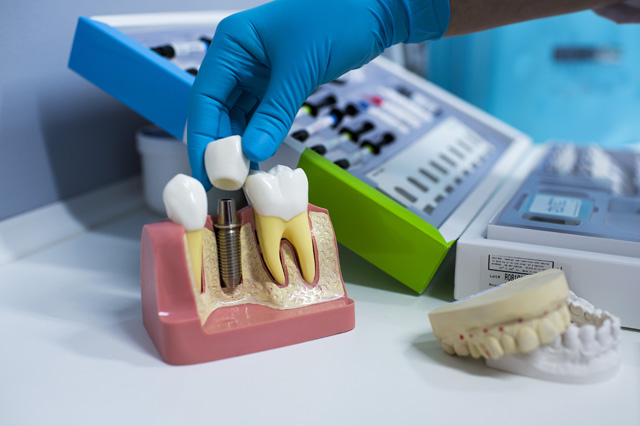Здоровье зубов: все об имплантации (фото 2)